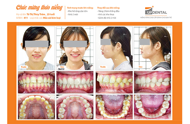 Sự thay đổi trước và sau khi niềng răng