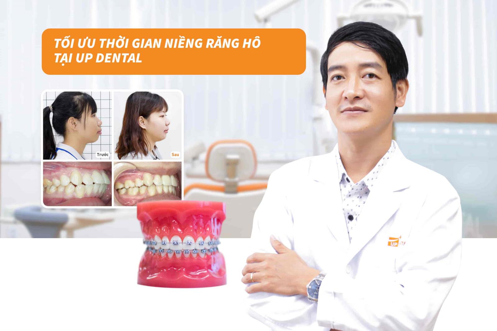 Tối ưu thời gian niềng răng hô tại Up Dental 