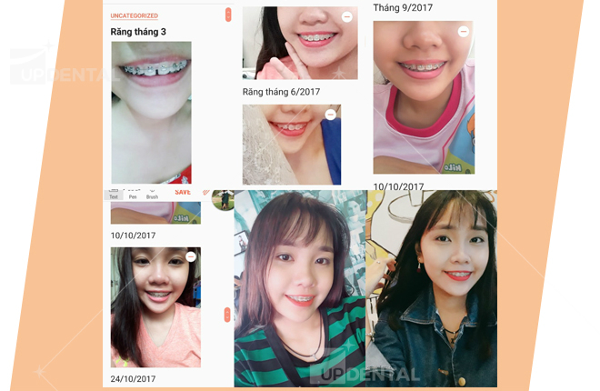 tong hop anh truoc va sau khi deo nieng