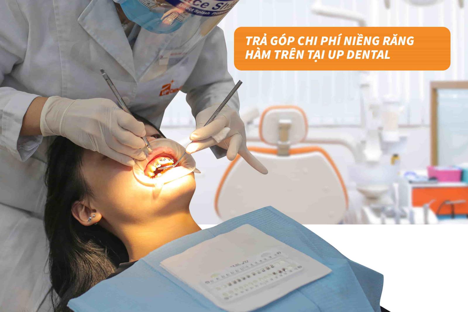 Trả góp chi phí niềng răng hàm trên tại Up Dental