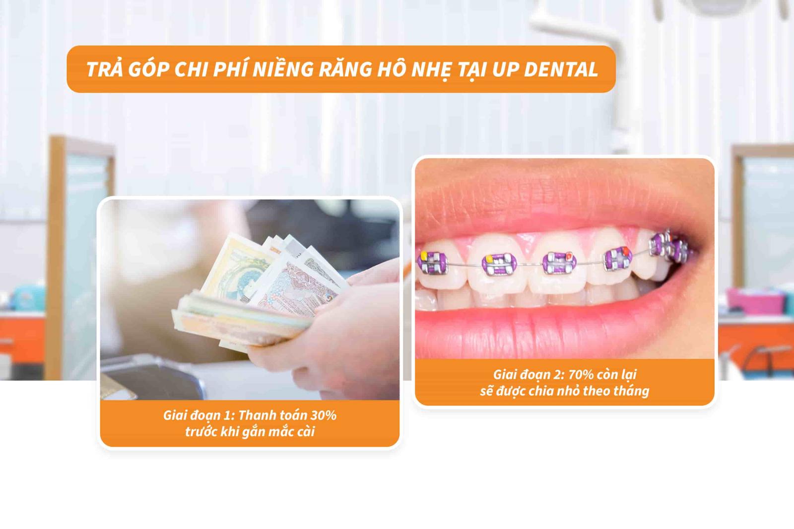 Trả góp chi phí niềng răng hô nhẹ tại Up Dental