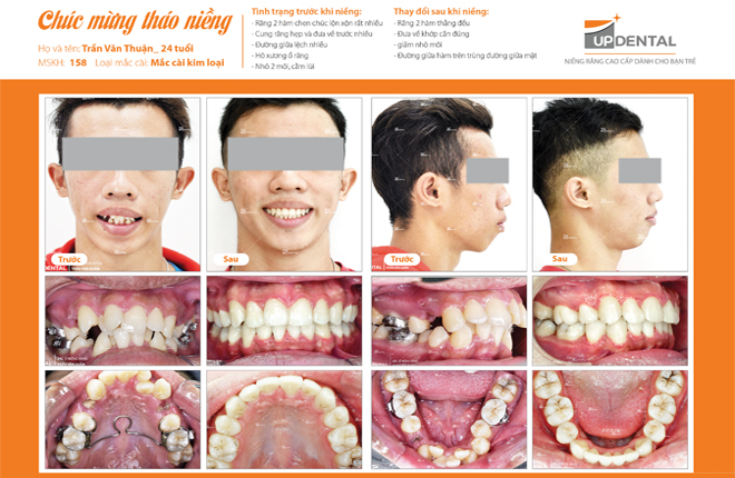 Hình ảnh trước và sau khi tháo niềng