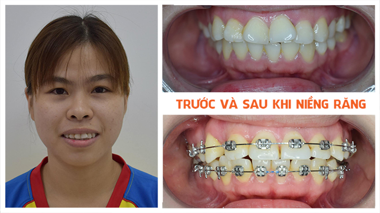 review ket qua nieng rang ho rang lech lac tai up dental