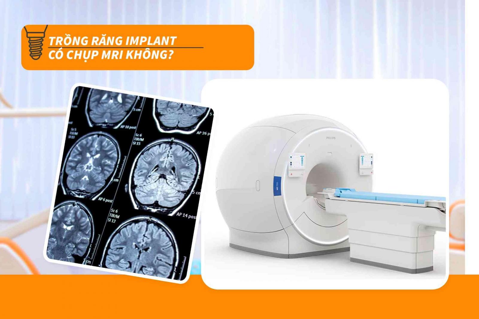 Trồng răng Implant có chụp MRI không?