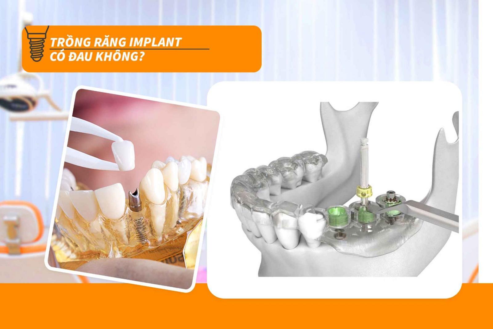 Trồng răng Implant có đau không
