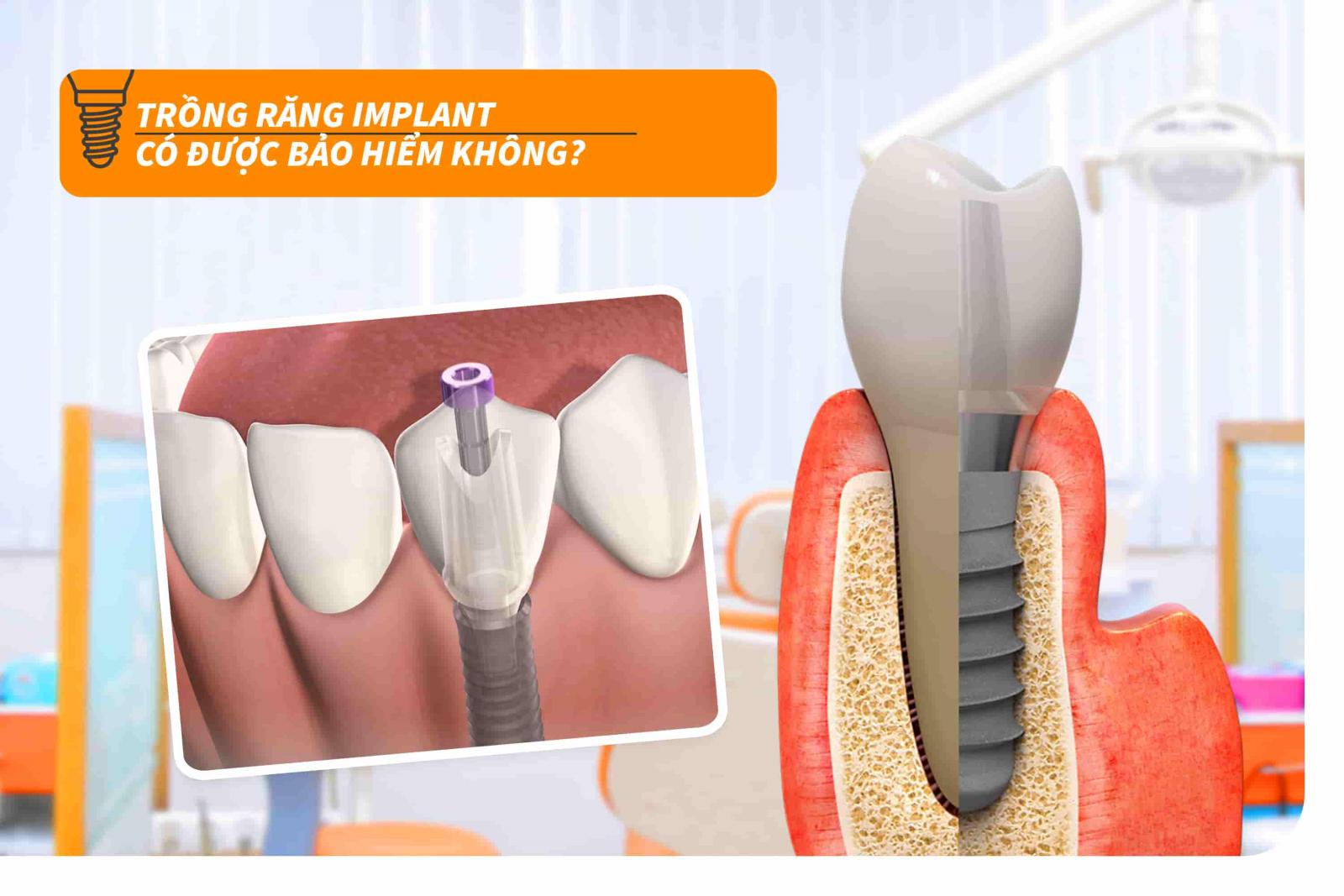 Trồng răng Implant có được bảo hiểm không?