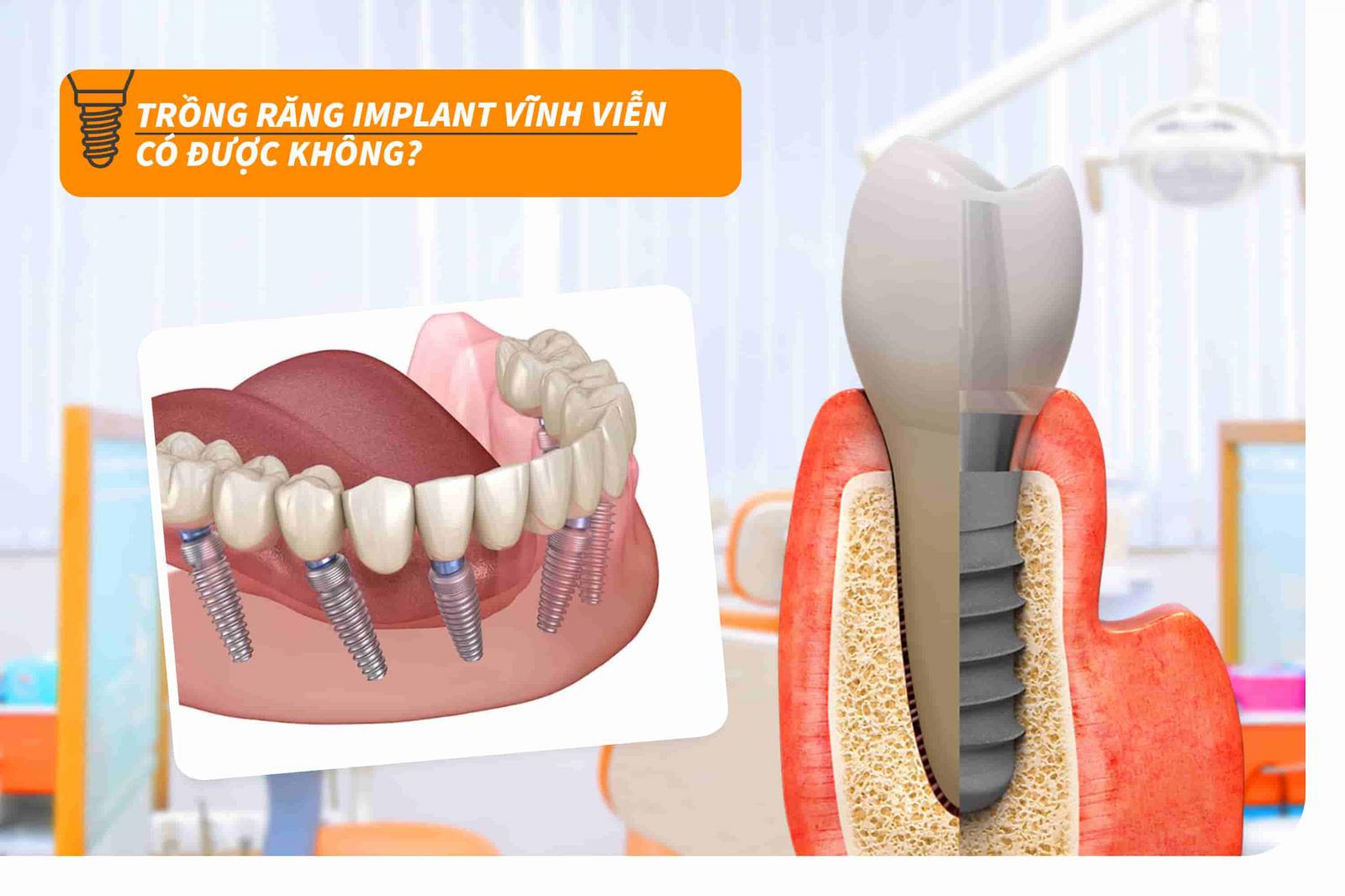 Trồng răng Implant vĩnh viên có được không?