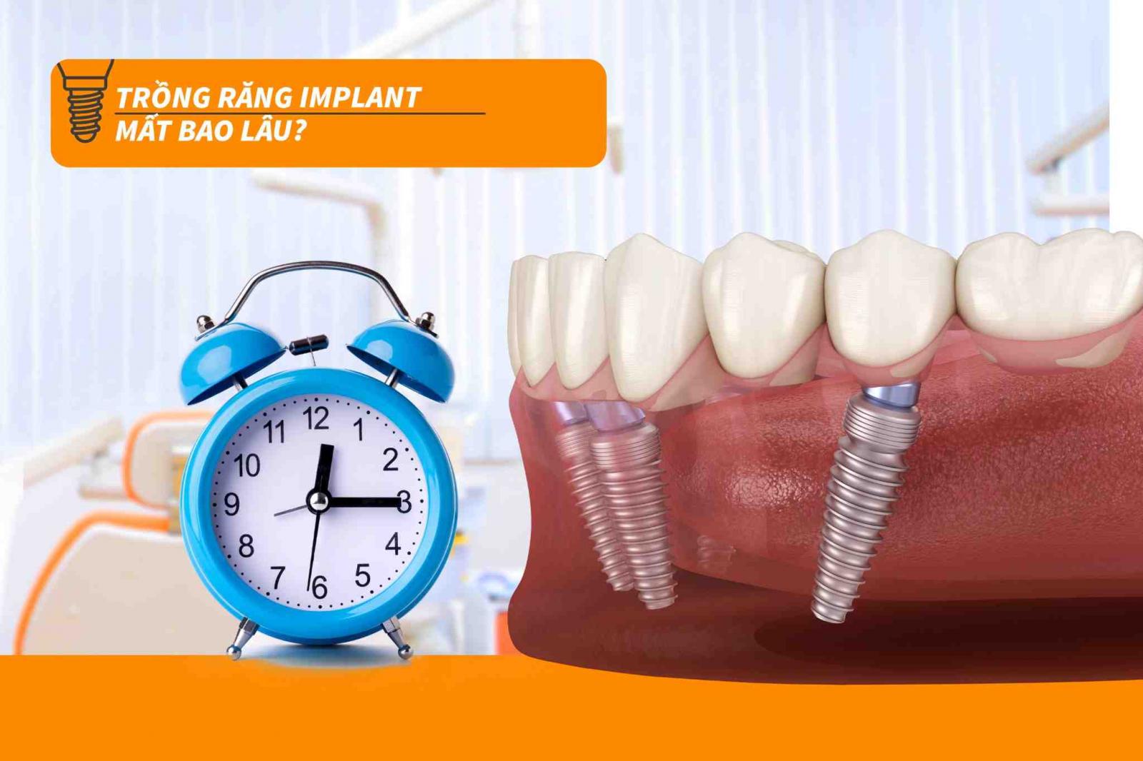 Trồng răng Implant mất bao lâu?