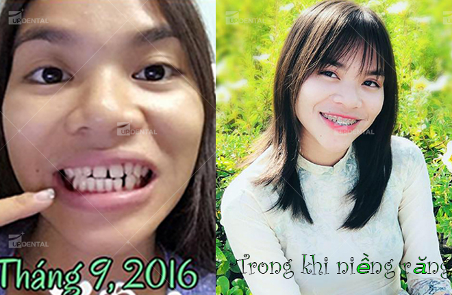 anh truoc va sau khi nieng rang