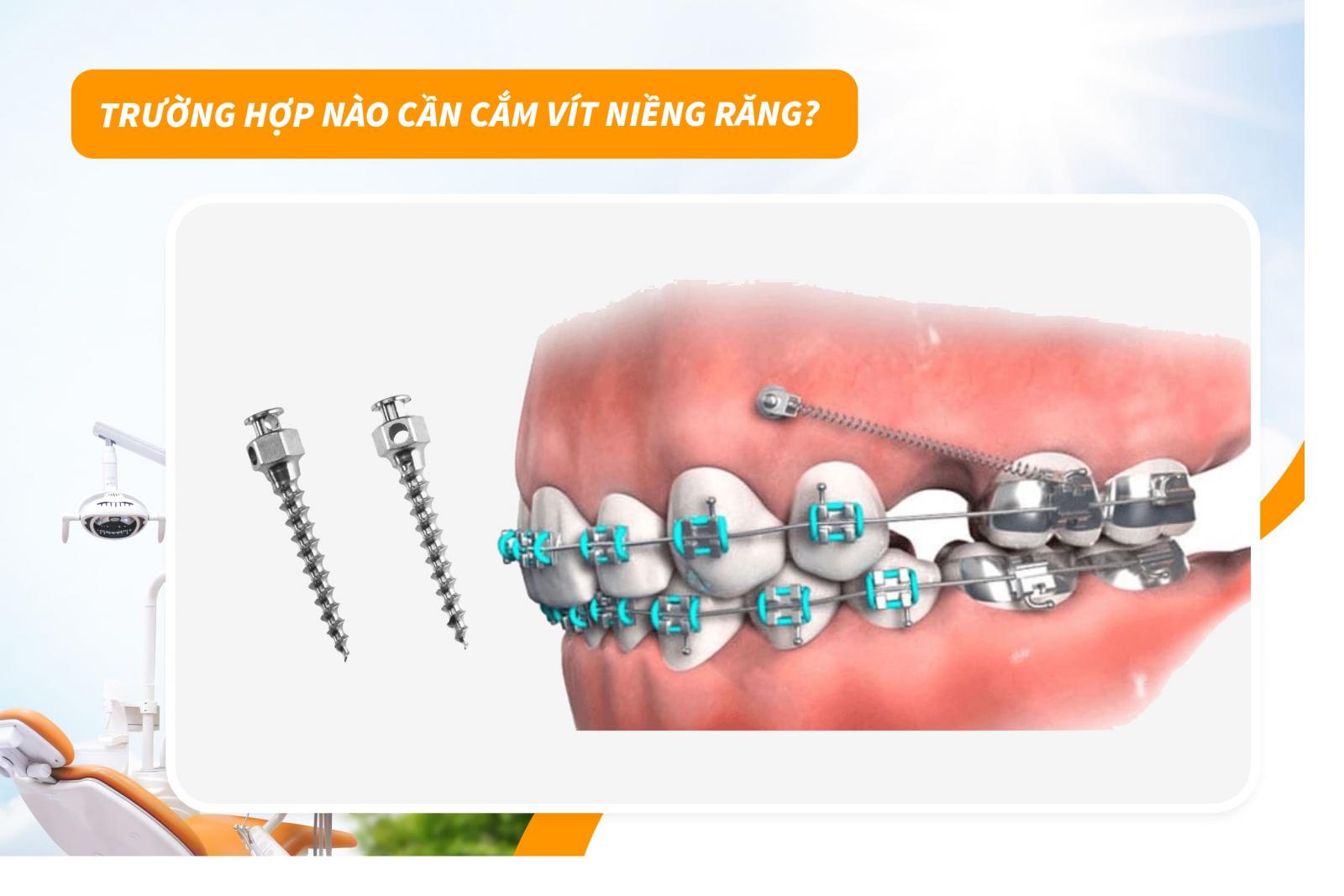 Trường hợp nào cần cắm vít niềng răng?
