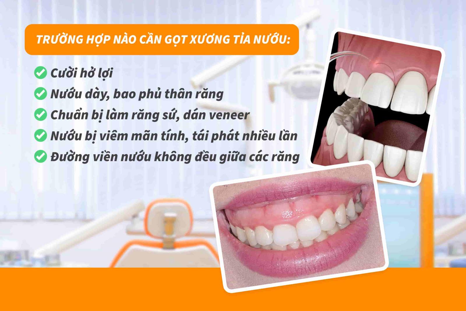Trường hợp nào cần gọt xương tỉa nướu