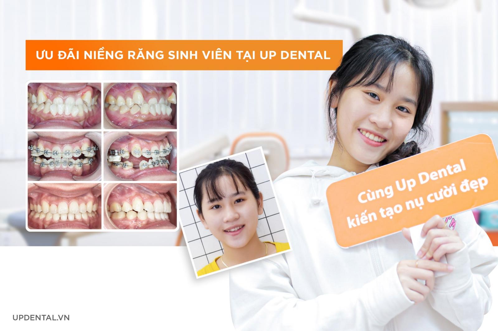 niềng răng cho sinh viên tại Up Dental