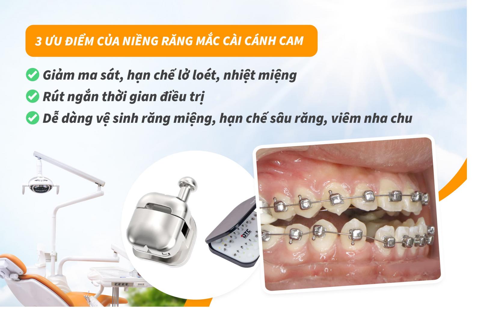 Ưu điểm của niềng răng mắc cài cánh cam