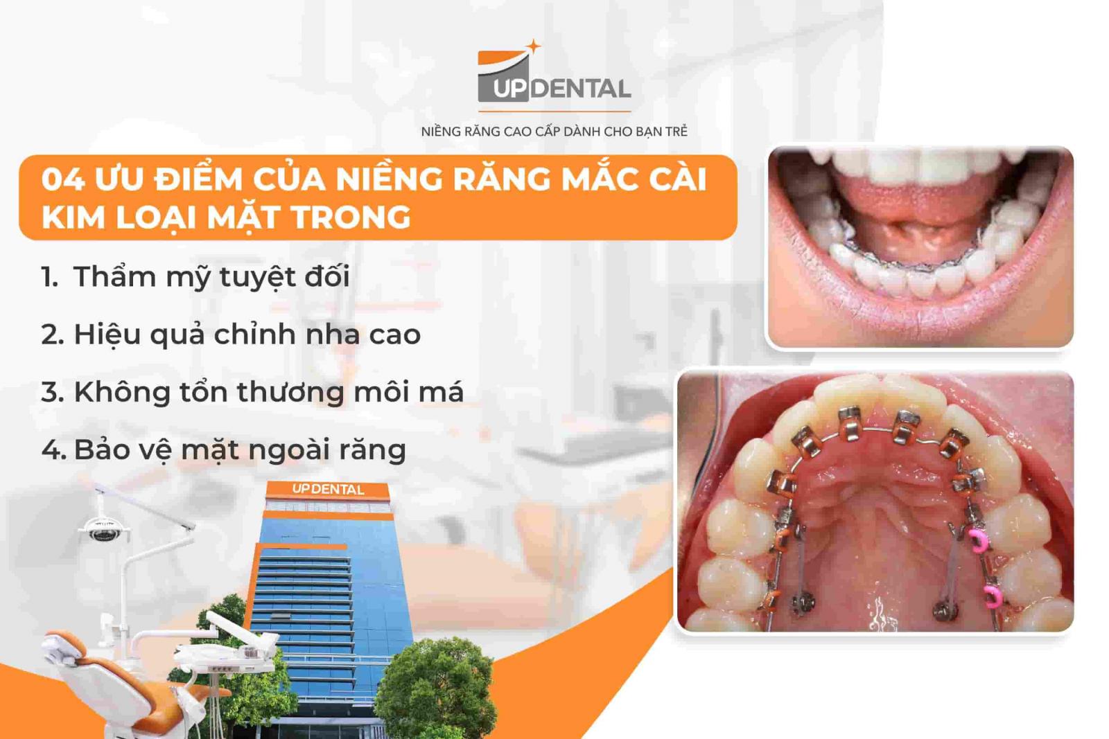 04 ưu điểm của niềng răng mắc cài kim loại mặt trong