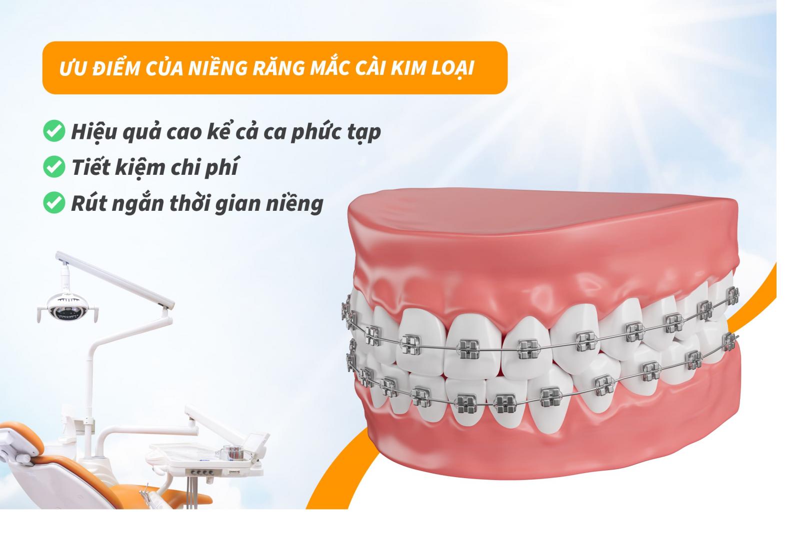 Ưu điểm của niềng răng mắc cài kim loại