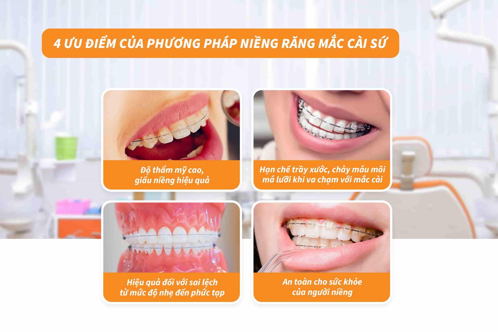 04 ưu điểm của phương pháp niềng răng mắc cài sứ