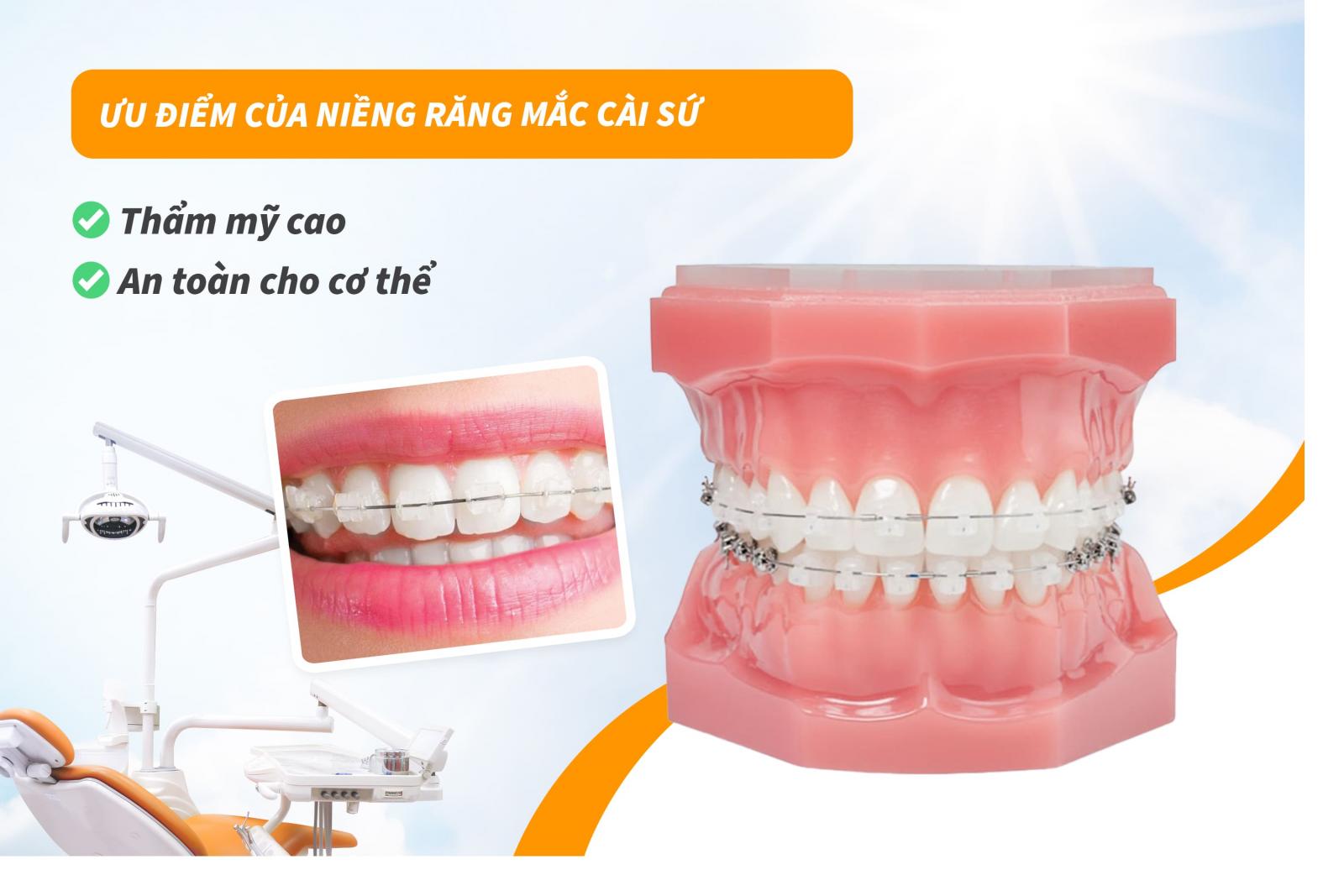 Ưu điểm của niềng răng mắc cài sứ