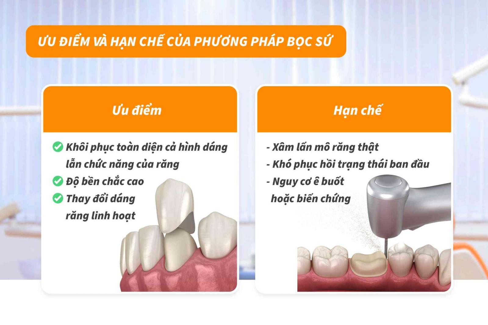 Ưu điểm và hạn chế của bọc sứ