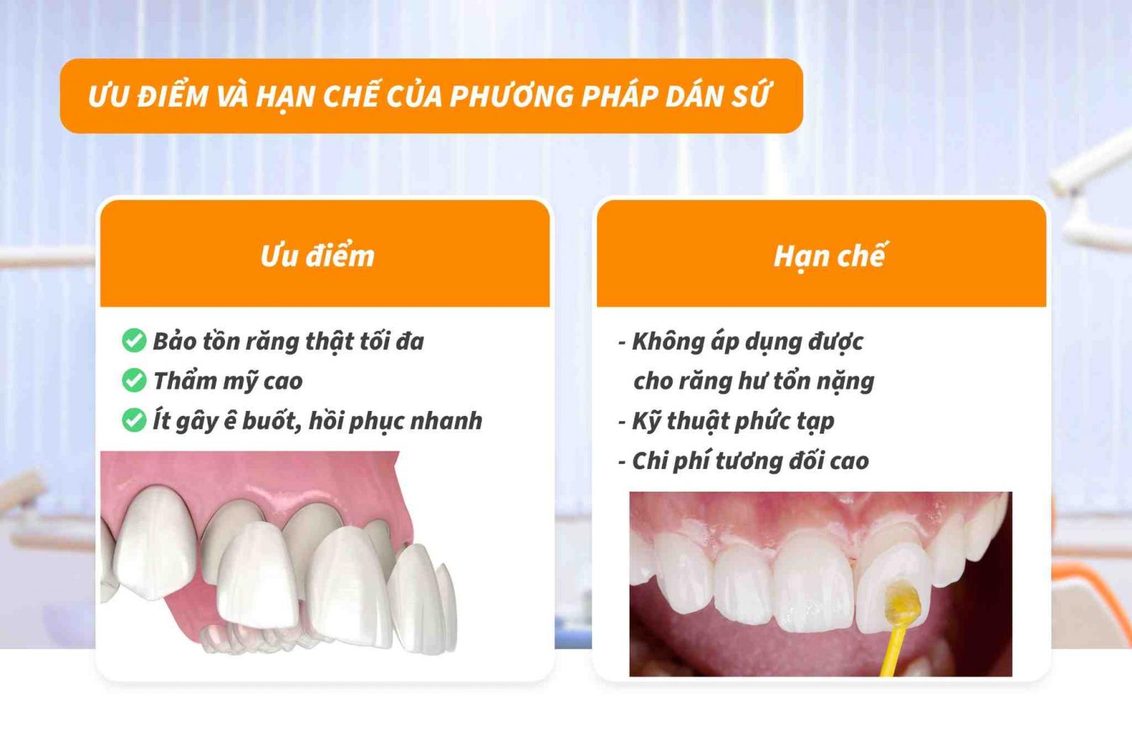Ưu điểm và hạn chế của dán răng sứ