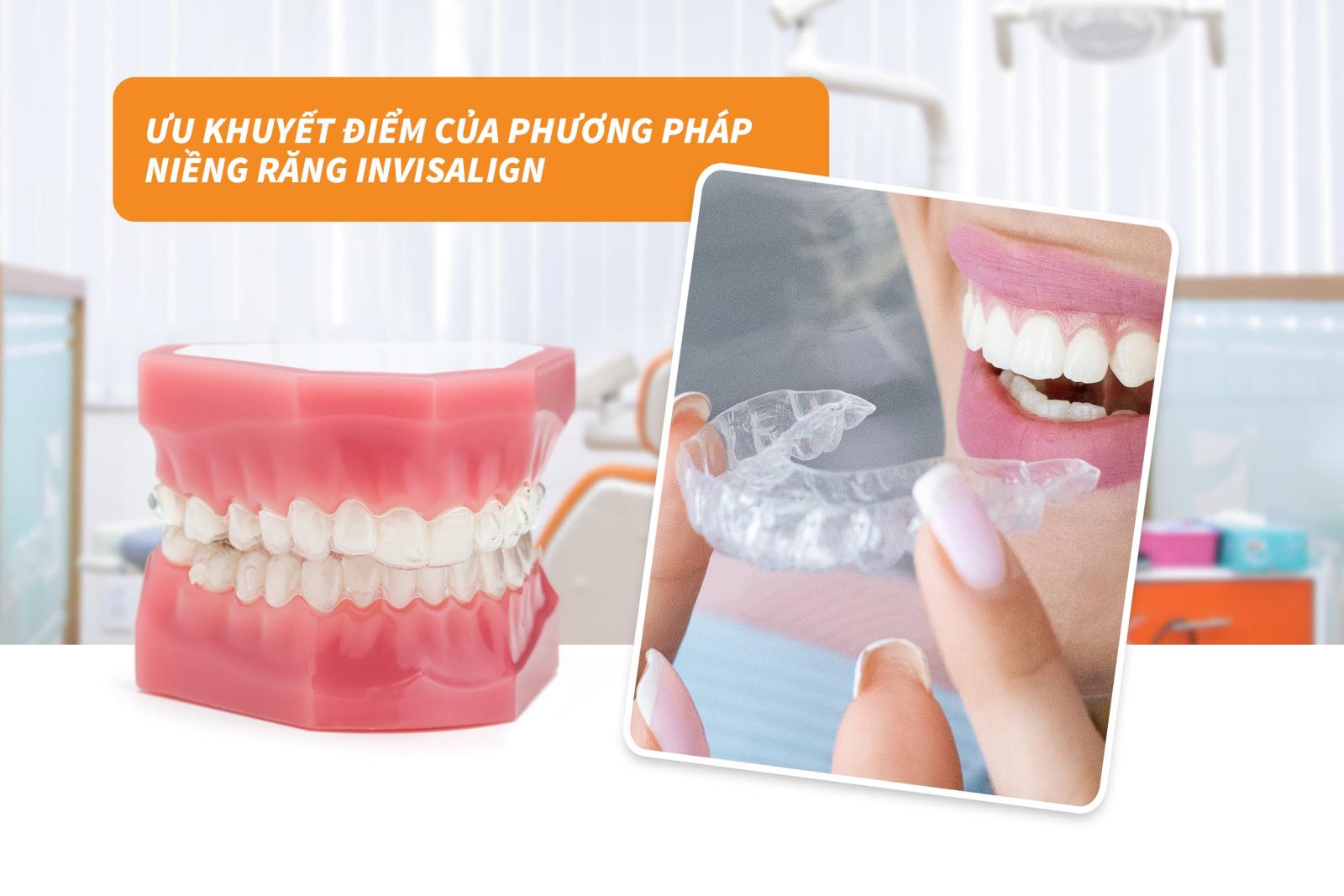 Ưu điểm và hạn chế của phương pháp niềng răng Invisalign