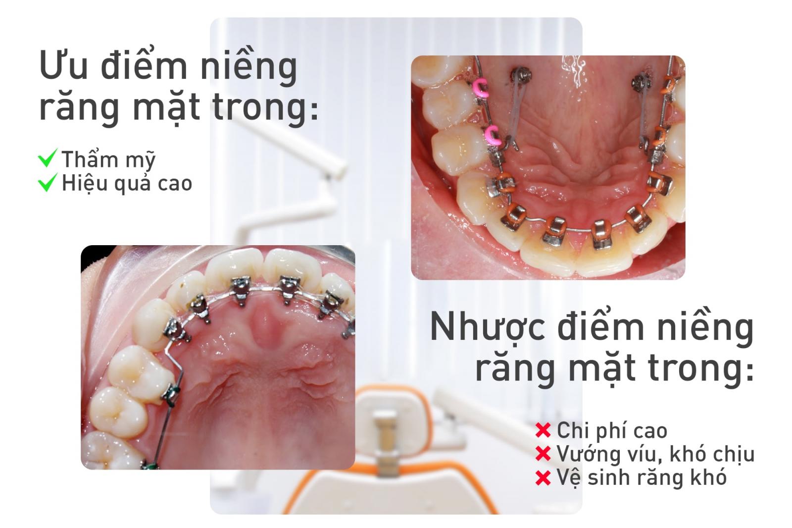 Niềng răng mặt trong là gì? Chi phí và những ưu nhược điểm | Up Dental