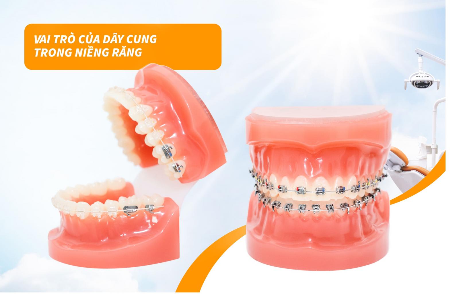 Vai trò của dây cung trong niềng răng