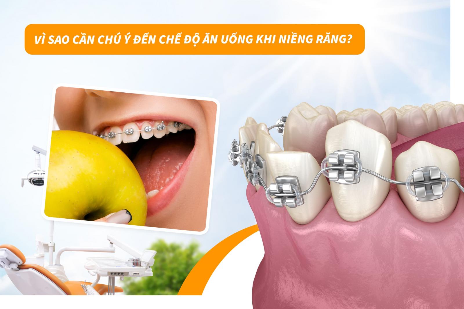 Vì sao cần chú ý đến chế độ ăn uống khi niềng răng?