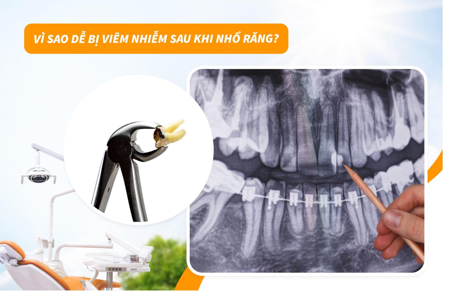 Vì sao dễ bị viêm nhiễm sau khi nhổ răng?