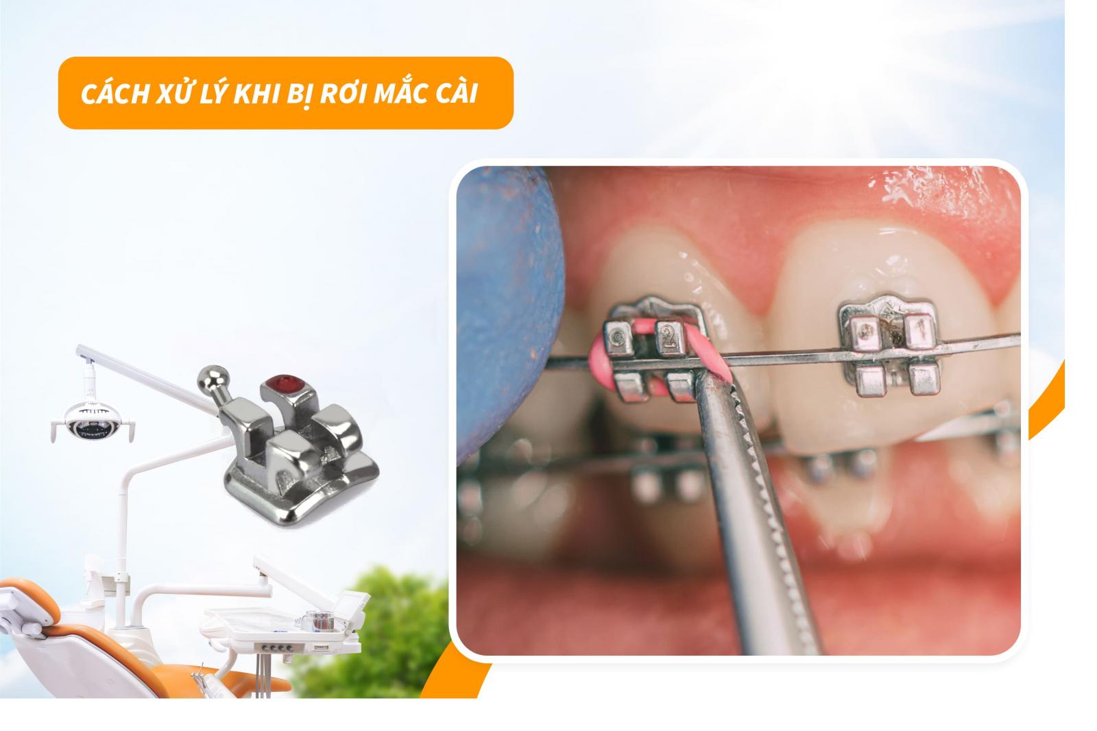 Xử lý khi bị rơi mắc cài