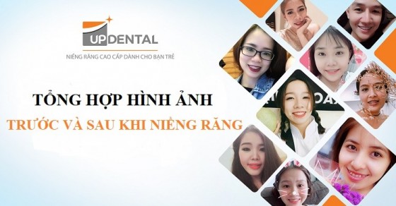 Cách thức niềng răng hô như thế nào?
