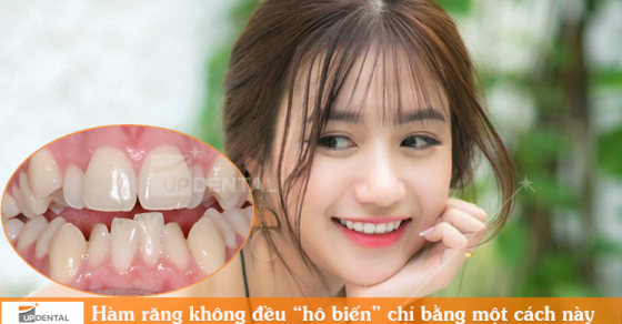 Tình trạng răng hàm dưới không đều có thể ảnh hưởng đến hàm trên như thế nào?
