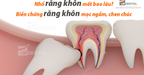 Nhổ răng khôn lâu không có thể gây những vấn đề sức khỏe nào?