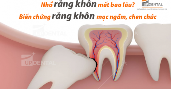 Nhổ răng khôn trong bao lâu?