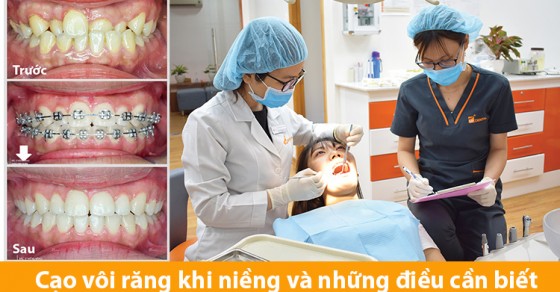 Có nên niềng răng có cạo vôi răng được không hay không?