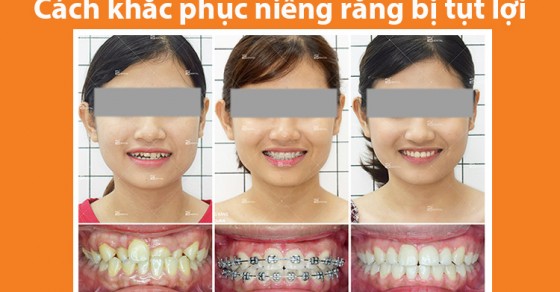 Có cách nào ngăn ngừa tụt lợi khi niềng răng không?
