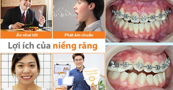 Tiến trình niềng răng như thế nào?
