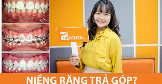 Niềng răng trong suốt có gắn kết chặt vào răng hay có thể tháo ra được?
