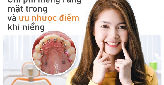 What is the average cost of niềng răng mắc cài mặt trong (inner face braces) at Up Dental dental clinic?