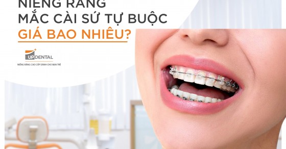 Đặc điểm và ưu điểm của phương pháp niềng răng mắc cài sứ tự đóng?

