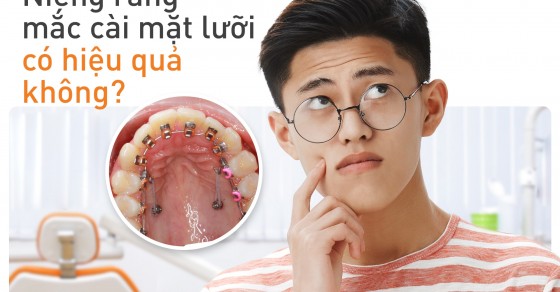 What is the process and structure of niềng răng mặt lưỡi?