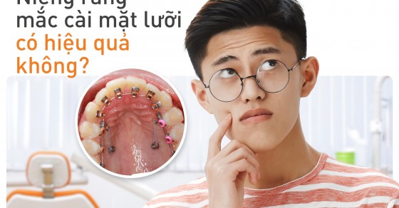 Tìm hiểu về niềng răng mặt lưỡi và ưu điểm của phương pháp này