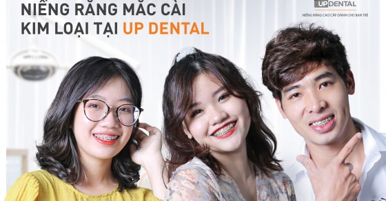 Những vật liệu sử dụng trong niềng răng mắc cài kim loại là gì?
