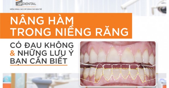 Quá trình niềng răng có cần nâng hàm không?
