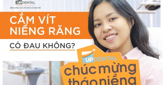 Có những loại vít nào được sử dụng khi niềng răng?
