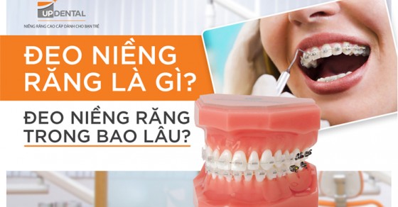 Đeo Niềng Răng Trong Bao Lâu Lưu ý Khi đeo Niềng Răng Up Dental 5611