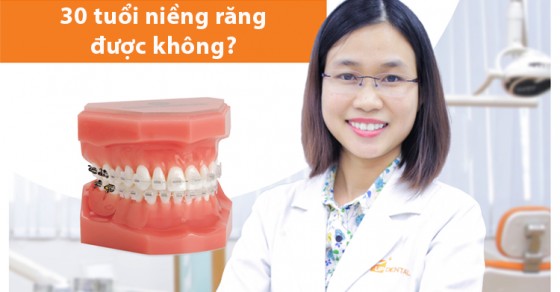 Ở tuổi 30, liệu có cần phải nhổ răng trước khi niềng?
