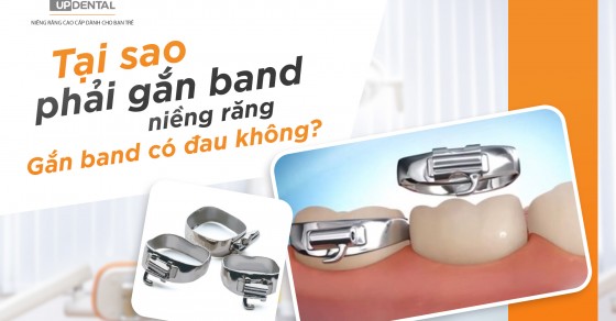 Band răng có tác động như thế nào đến quá trình chuyển động của răng?
