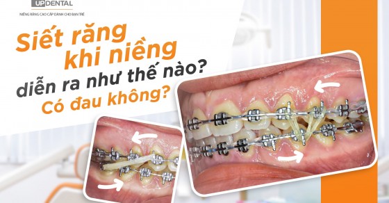 Cảm giác đau nhức sau khi siết răng khi niềng thường kéo dài bao lâu?
