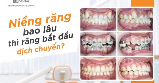 Có thể tận dụng kết quả niềng răng sau 1 tháng để cải thiện nụ cười không hoàn hảo?
