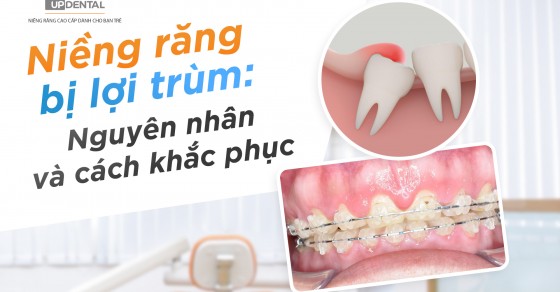 Tác dụng và cách niềng răng lợi trùm khi niềng răng hỗ trợ nha khoa hiệu quả